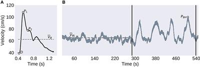 Sex-Based Differences in Transcranial Doppler Ultrasound and Self-Reported Symptoms After Mild Traumatic Brain Injury